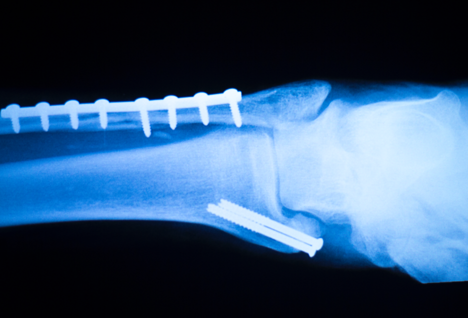 How Do Titanium Plates Help Bones Heal? Insights from Supra Alloys – A Medical Grade Titanium Supplier in Philadelphia, Pennsylvania